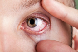 Αίτια και συμπτώματα της ξηροφθαλμίας